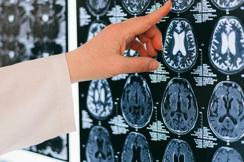 A doctor points at brain imaging scans on a wall.