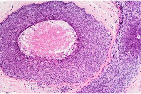 Breast cancer cells.