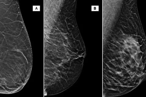 Breast density