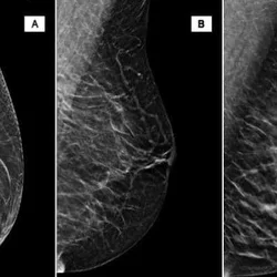 Breast density